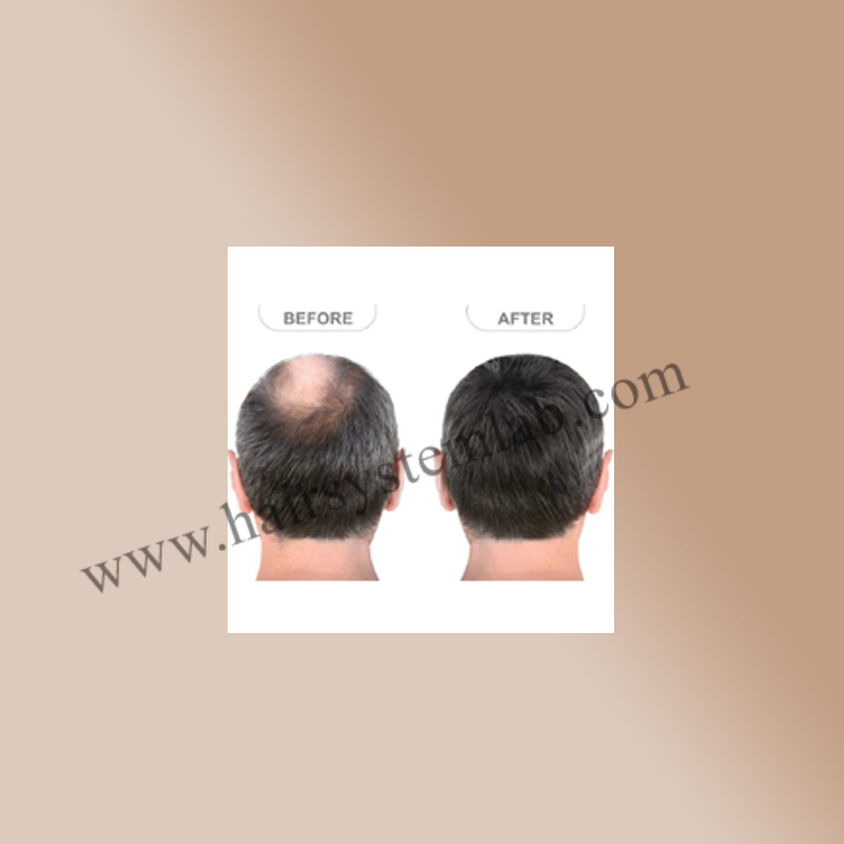 Hair Replacement